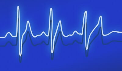 Cardiac Pulsation