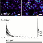 Calcium1_autoigg_automated_functional_screening_igg_diagnostics_neurodegenerativedieases_rise