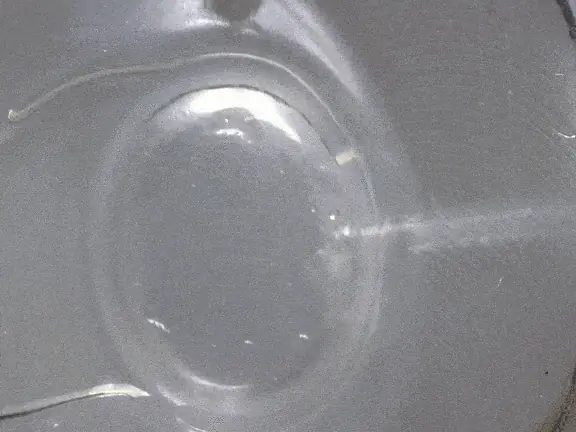 Glaucoma drainage device video Glaucoma drainage device video